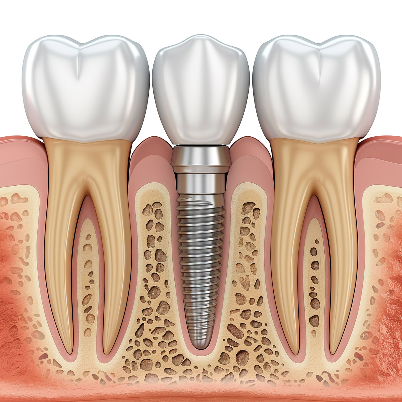 aktif dent implant AKTİF DENT www.aktifdent.com.tr info@serbia.com.tr 05399280551